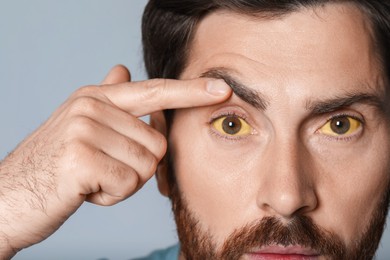 Man with yellow eyes on grey background, closeup. Symptom of hepatitis