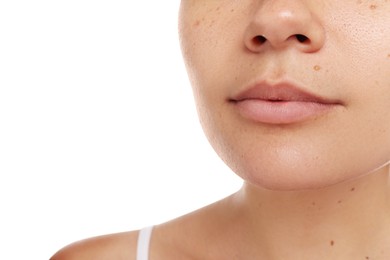 Closeup view of woman`s face with birthmarks on white background