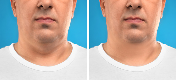 Mature man before and after plastic surgery operation on blue background, closeup. Double chin problem