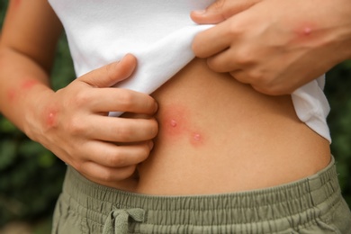 Woman scratching abdomen with insect bites outdoors, closeup