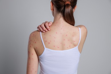 Photo of Woman with rash suffering from monkeypox virus on light grey background, back view