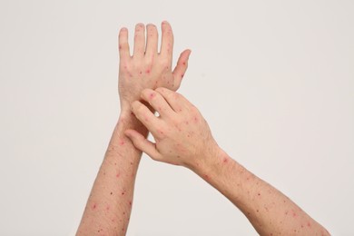 Man with rash suffering from monkeypox virus on beige background, closeup