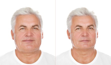 Double chin problem. Collage with photos of senior man before and after plastic surgery procedure on white background