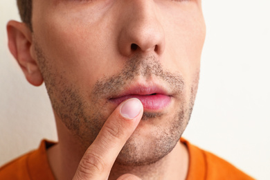 Young man with cold sore applying cream on lips against white background, closeup