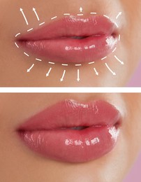 Collage with photos of young woman before and after lips augmentation procedure, closeup