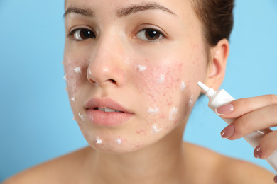 Teen girl with acne problem applying cream on light blue background