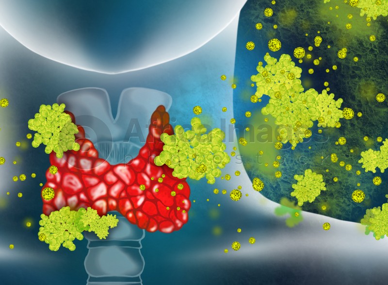 Illustration of human thyroid cancer on color background