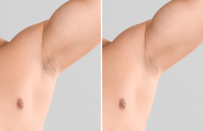 Collage of man showing armpit before and after epilation on light grey background, closeup 