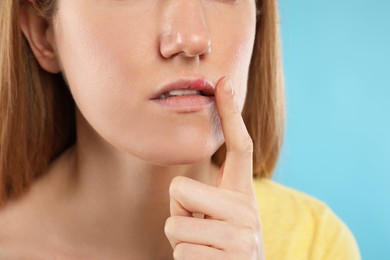 Photo of Woman suffering from herpes on light blue background, closeup