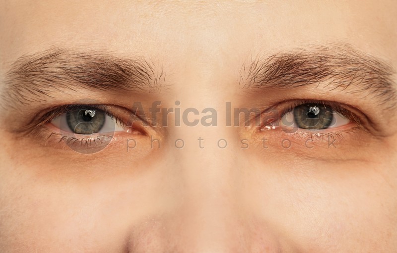Tired man with dark circles under eyes, closeup