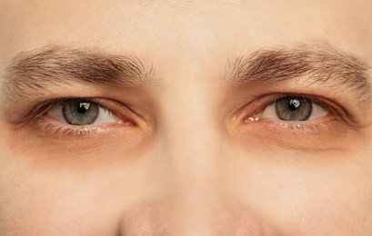 Tired man with dark circles under eyes, closeup