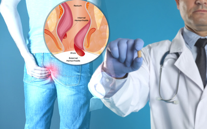 Doctor holding suppository near man suffering from hemorrhoid pain. Illustration of unhealthy lower rectum