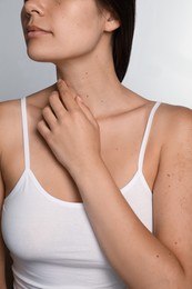 Closeup view of woman`s body with birthmarks on light grey background