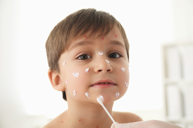 Doctor applying cream onto skin of little boy with chickenpox in clinic. Varicella zoster virus