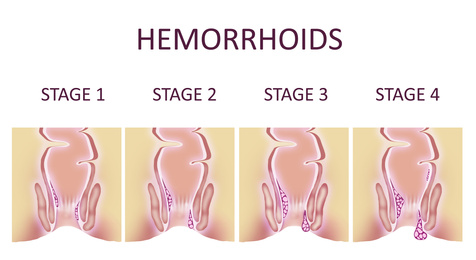 Hemorrhoid stages. Illustration of unhealthy lower rectum with inflamed vascular structures, banner design