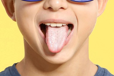 Boy showing tongue with white patches on yellow background, closeup. Oral candidiasis (thrush) disease