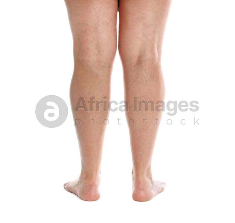 Photo of Woman's legs with varicose on white background, closeup