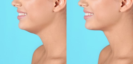 Double chin problem. Collage with photos of young woman before and after plastic surgery procedure on turquoise background, closeup