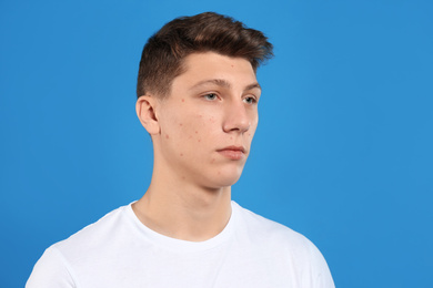 Photo of Teen guy with acne problem on blue background
