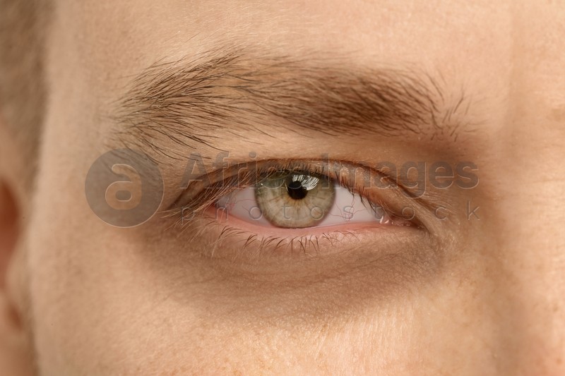Tired man with dark circle under eye, closeup