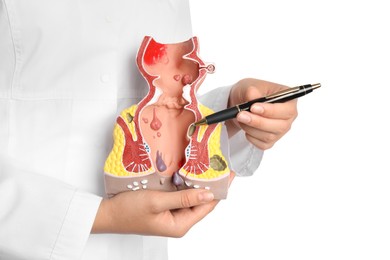 Photo of Doctor pointing at model of unhealthy lower rectum with inflamed vascular structures on white background, closeup. Hemorrhoid problem
