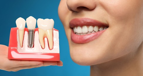 Young woman with beautiful smile and dentist holding educational model of dental implant on blue background, closeup