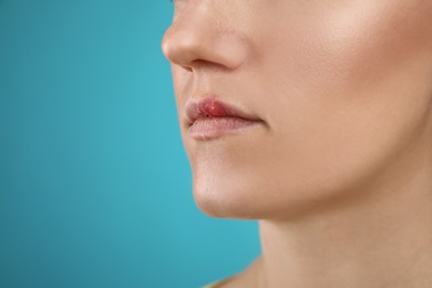 Photo of Woman suffering from herpes on light blue background, closeup. Space for text