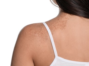 Closeup of woman`s body with birthmarks on white background, back view