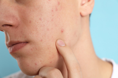 Photo of Teen guy with acne problem on light blue background, closeup