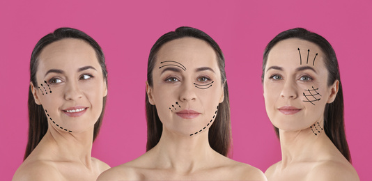 Photos of mature woman with lifting marks on face against pink background, collage. Cosmetic surgery
