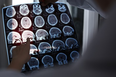 Doctors examining MRI images of patient with multiple sclerosis in clinic, closeup