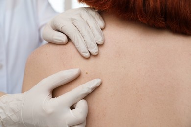 Dermatologist examining patient's birthmark in clinic, closeup view
