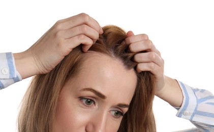 Woman suffering from baldness on white background, closeup