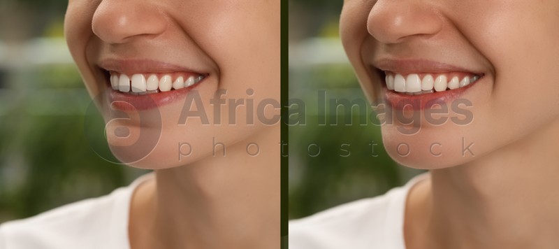 Collage with photos of woman with diastema between upper front teeth before and after treatment on blurred background, closeup. Banner design