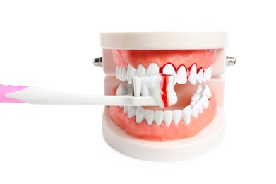 Model of jaw, brush and toothpaste foam with blood on white background. Gum problems
