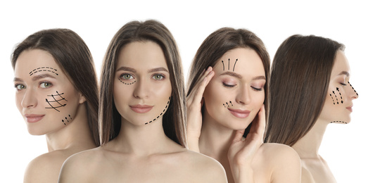 Photos of young woman with lifting marks on face against white background, collage. Cosmetic surgery