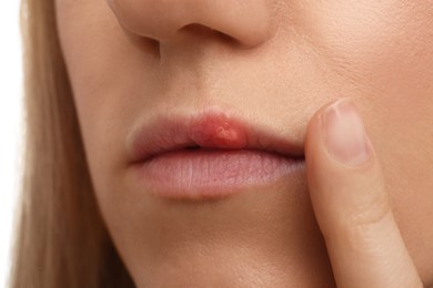 Woman suffering from herpes, closeup. Dermatological problem