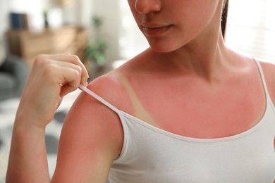 Photo of Woman with sunburned skin at home, closeup