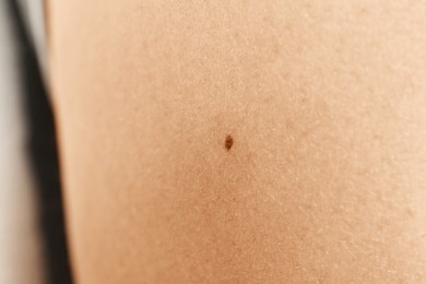 Closeup view of woman's body with birthmark