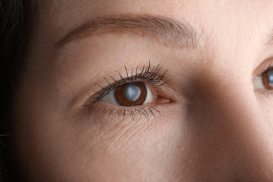 Closeup view of mature woman suffering from cataract