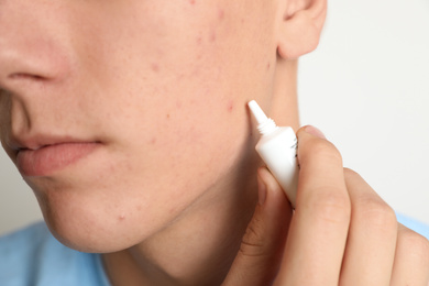 Teen guy with acne problem applying cream on light background, closeup