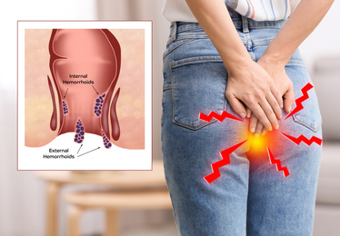 Young woman suffering from hemorrhoid pain at home, closeup. Illustration of unhealthy lower rectum