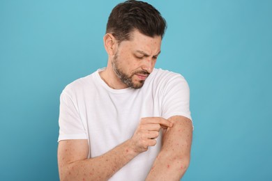 Photo of Man with rash suffering from monkeypox virus on light blue background