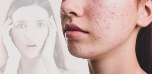 Woman with acne problem, closeup. Vision of scared girl suffering from phobia