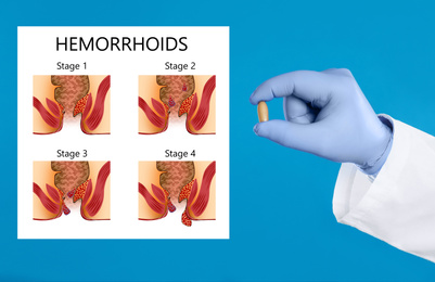 Image of Doctor holding suppository for hemorrhoid treatment near illustration of lower rectum progressing disease, blue background