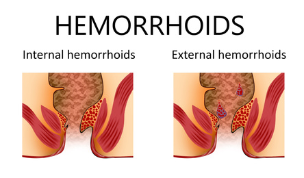 Hemorrhoid types. Unhealthy lower rectum with inflamed vascular structures, illustration