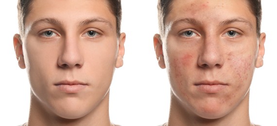 Image of Collage with photos of teen guy with acne problem before and after treatment on white background. Banner design
