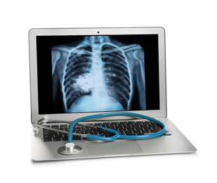 Laptop with x-ray of lung cancer patient on white background