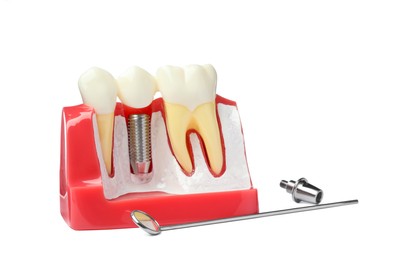 Educational model with post and crown of dental implant between teeth near mirror and abutment on white background
