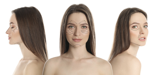 Photos of young woman with lifting marks on face against white background, collage. Cosmetic surgery